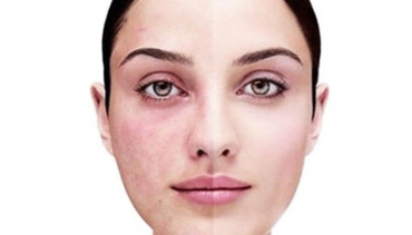 Laser Treatment For Rosacea